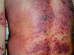 津门皮肤 接触性皮炎