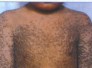 天津津门皮肤病医院鱼鳞病症状