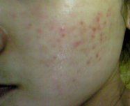 天津津门皮肤病医院 痤疮